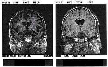 350px_Alzheimer__s_disease___MRI__dumb_version_.jpg